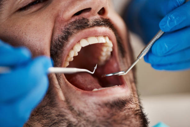 Best Emergency Dentist for Lost Fillings or Crowns in Tashua, CT